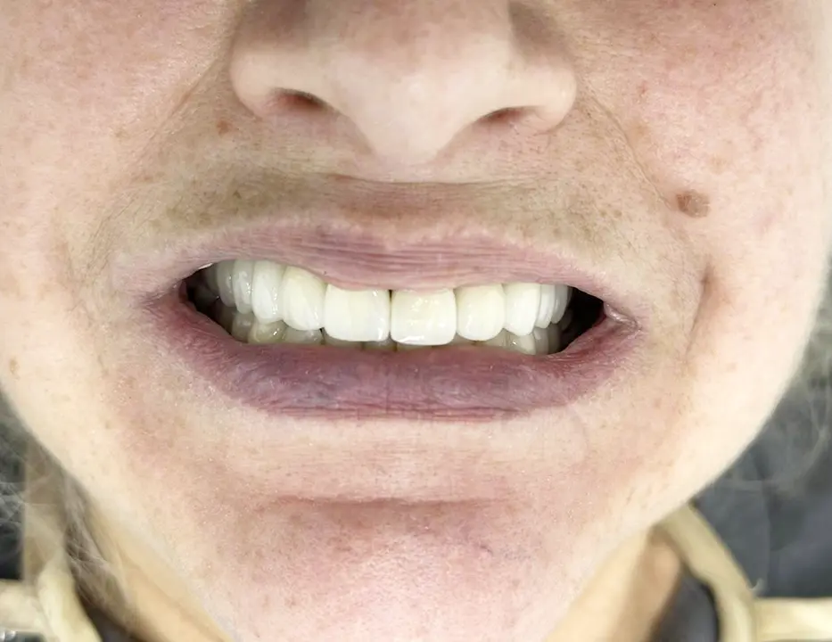 Dental Design Treatment